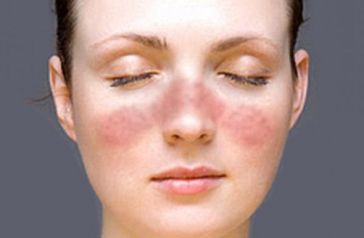 The 10 Symptoms That Mean You May Have Lupus | LifeDaily