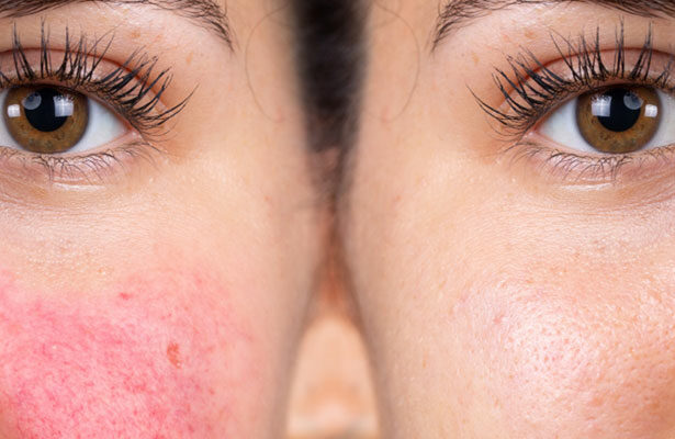 Is lupus a curable disease?