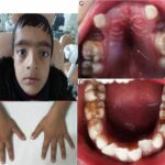 Understanding Cleidocranial Dysplasia: A rare genetic disorder affecting bones and teeth.