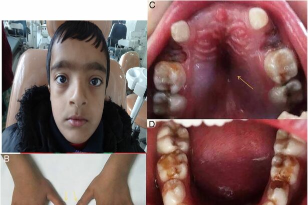 Understanding Cleidocranial Dysplasia: A rare genetic disorder affecting bones and teeth.