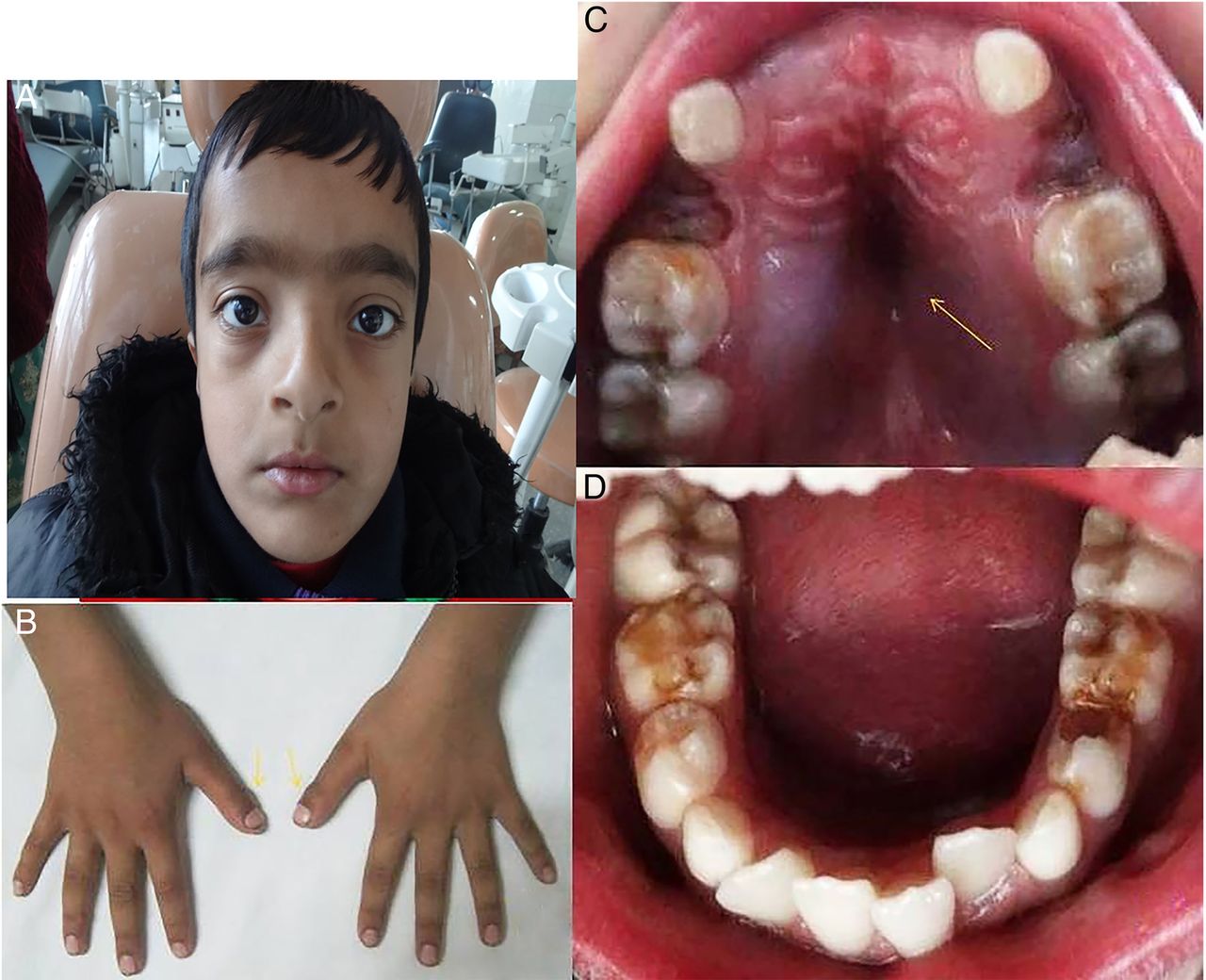 Understanding Cleidocranial Dysplasia: A rare genetic disorder affecting bones and teeth.