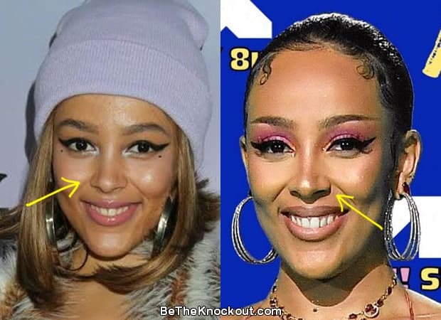 Doja Cat Plastic Surgery Comparison Photos